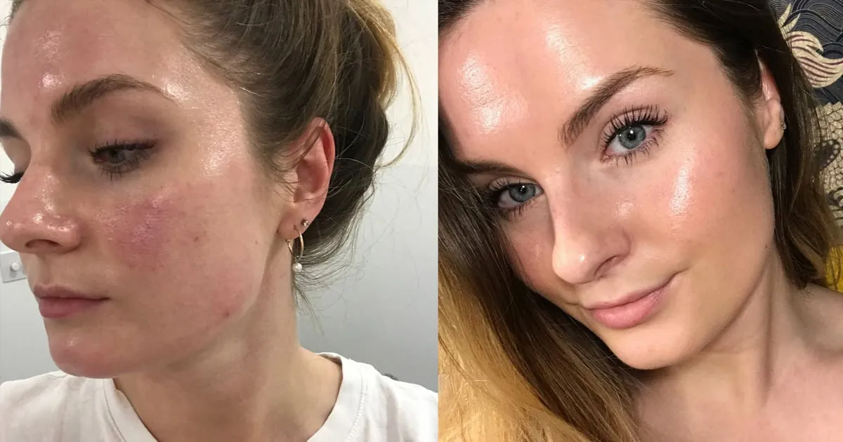 Before and after images of woman with broken capillaries