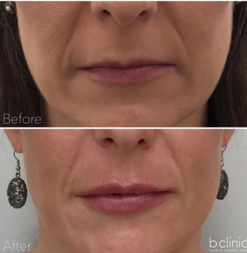 Lip Filler Aftercare - b clinic