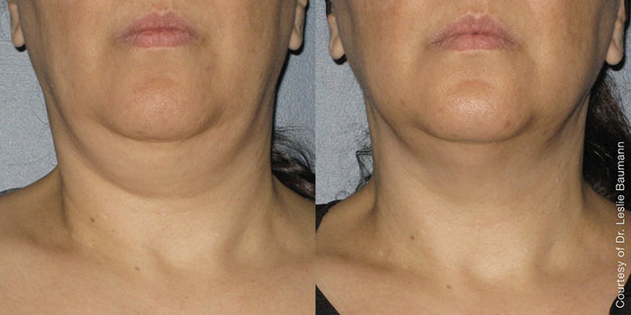 ultherapy-before-after-1