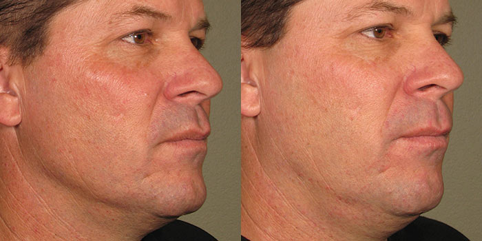 ultherapy-before-after-2