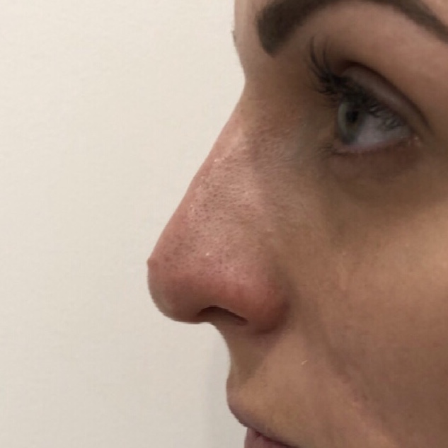 Nose filler treatment by Dr Mitch