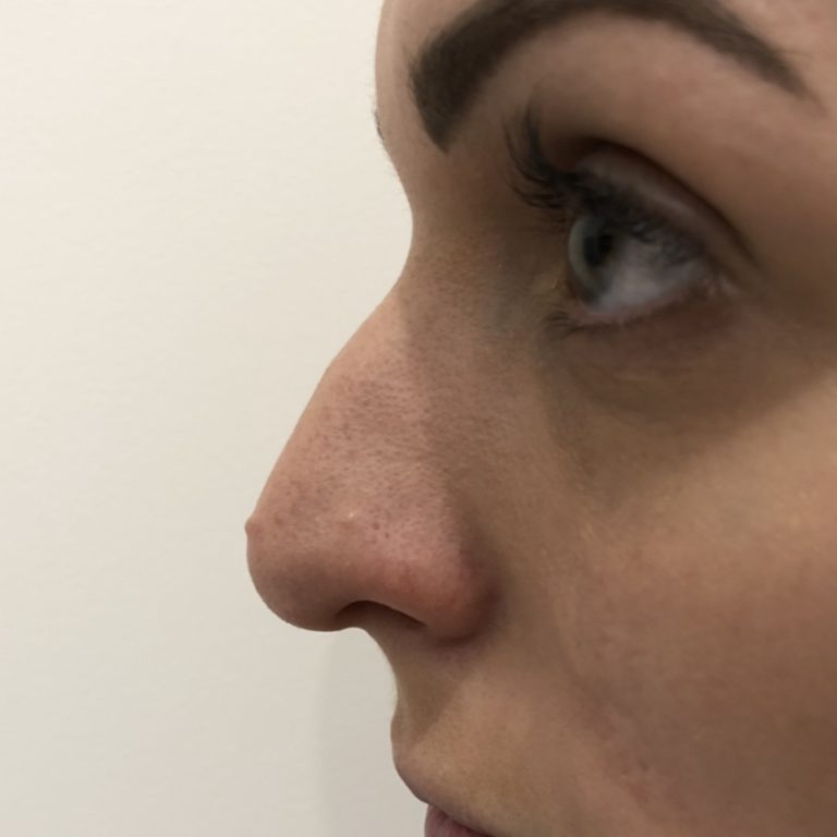 Before - Nose filler