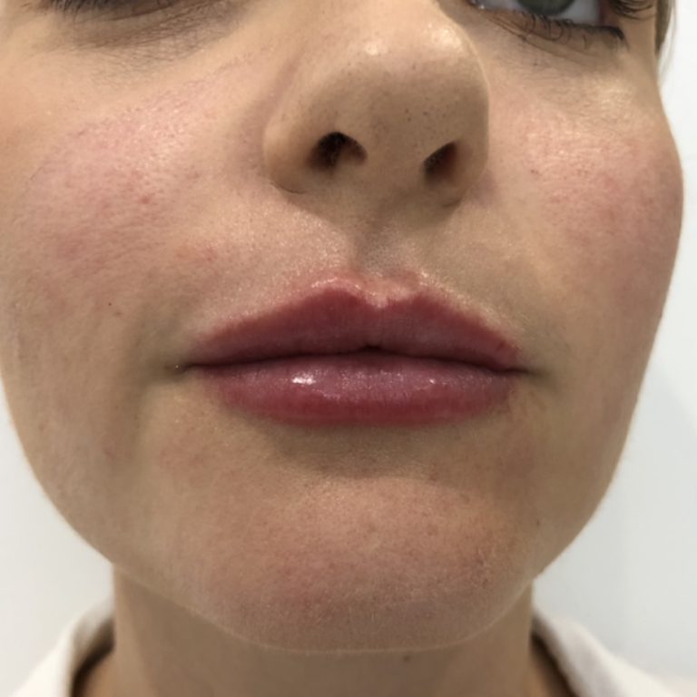 After - Lip filler