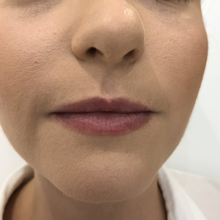 Before - Lip filler