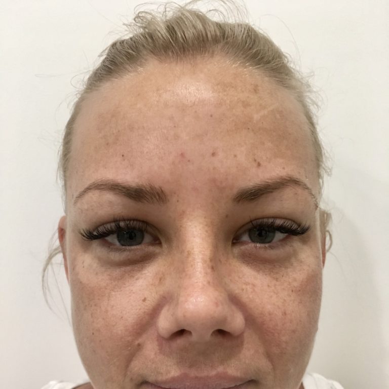 After - Forehead antiwrinkle