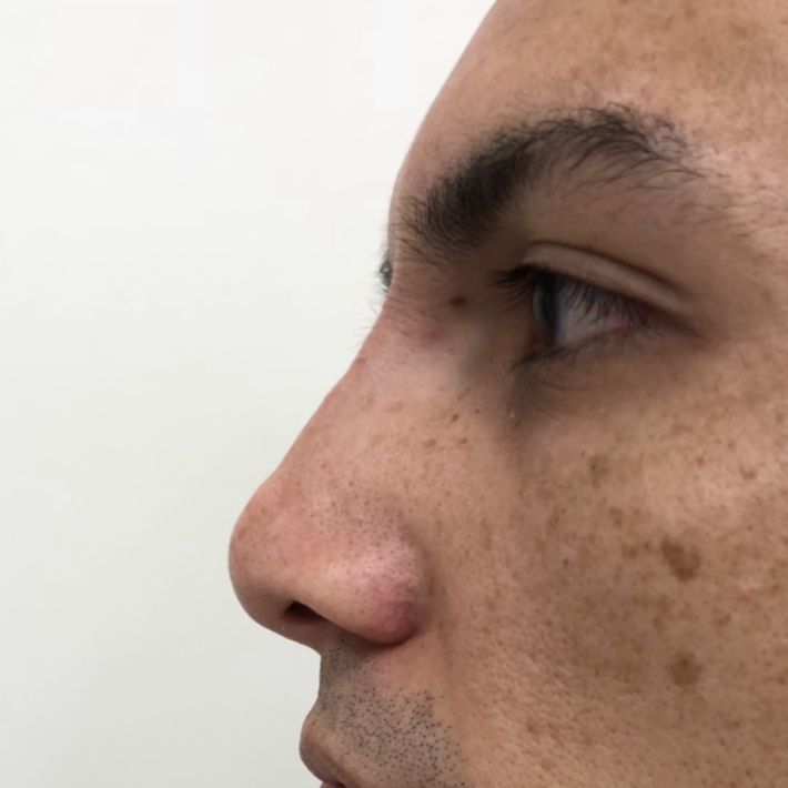 After - Nose filler