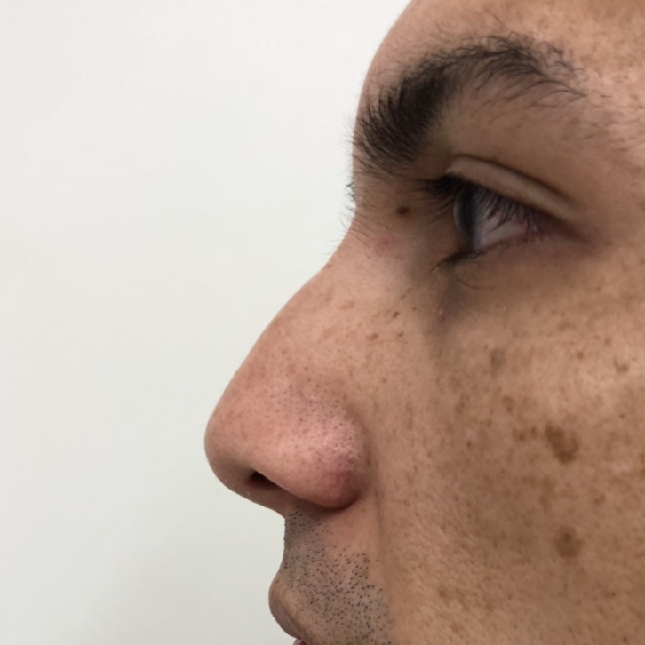 Before - Nose filler