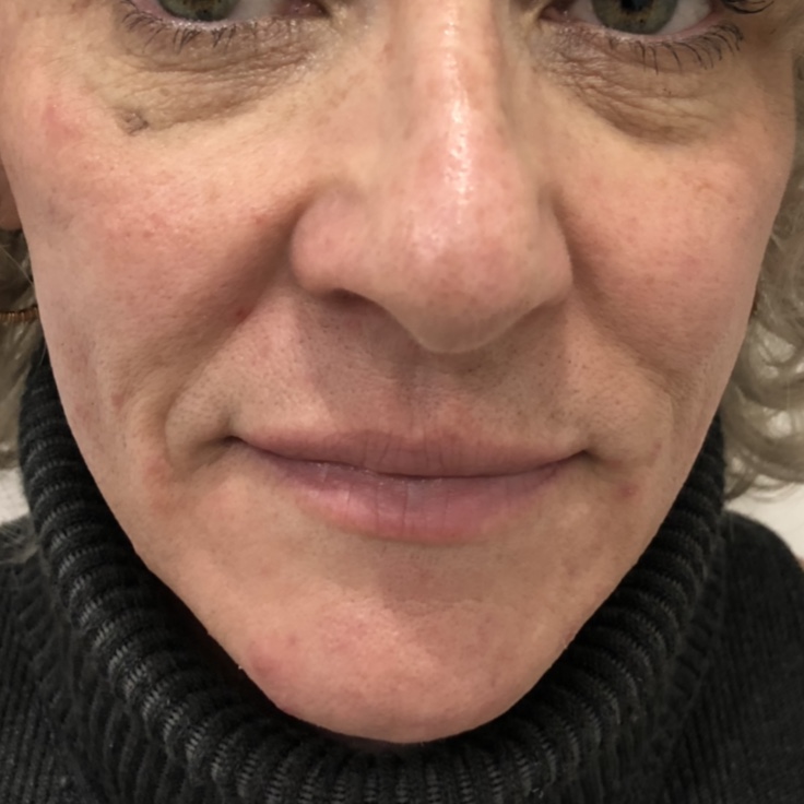 After - Midface filler