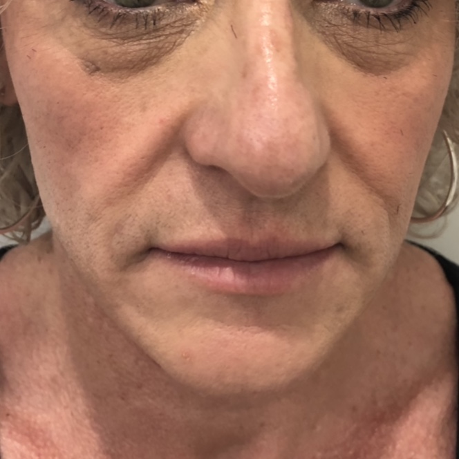 Before - Midface filler