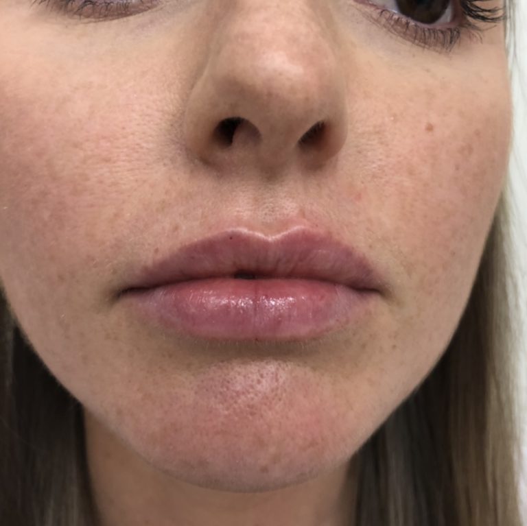 After - Lip filler