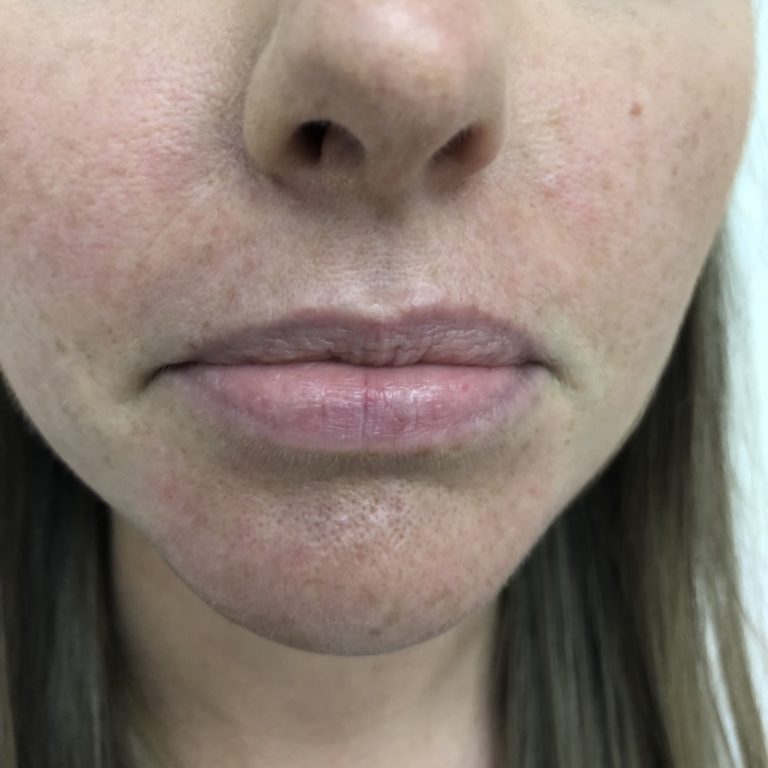 Before - Lip filler