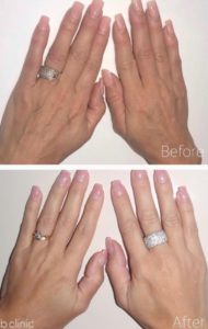 Biostiumlator filler hand treatment by Marian