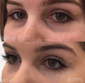 Dermal Filler tear trough treatment by Dr Frank