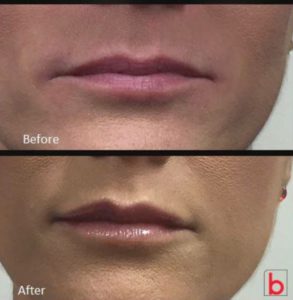 Dermal Filler lip refresher treatment by Dr Lee