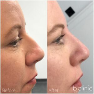 Dermal Filler nose treatment by Dr Luke