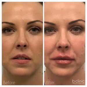 Dermal filler lip enhancement by Dr Lee