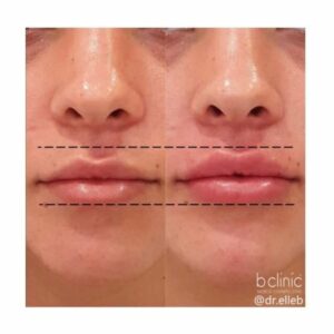 Dermal filler lip enhancement by Dr Elle