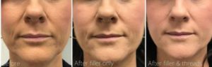 Dermal filler and Matrix PDO threads by Dr Lee & Marian