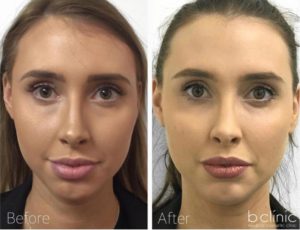 Dermal filler cheek, tear trough & chin enhancement by Dr Lee