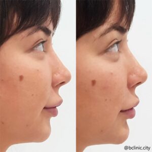 Dermal filler chin enhancement by Dr Elle