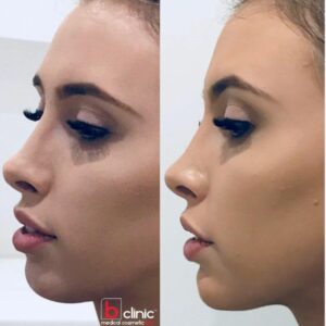 Dermal filler chin enhancement treatment by Dr Lee