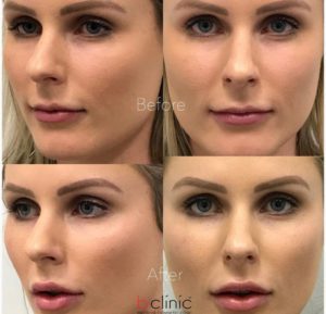 Dermal filler lip and cheek enhancement treatment