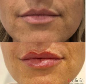 Dermal filler lip ehancement Marian