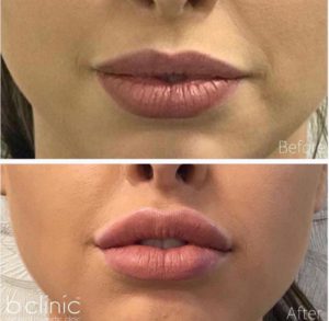 Dermal filler lip enhancement by Dr Lee