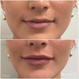 Dermal filler lip enhancement by Dr Ann-Marie