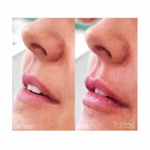 Dermal filler lip enhancement treatment by Dr Elle