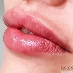 Dermal filler lip enhancement by Dr Elle