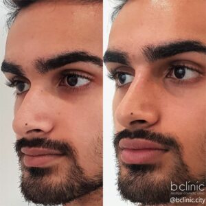 Dermal filler lip & nose enhancement treatment by Dr Elle