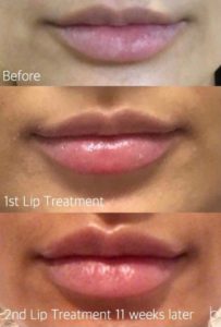 Dermal filler lip enhancement by Dr Lee