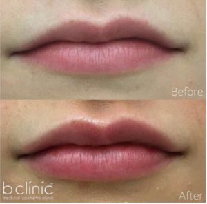 Dermal filler lip enhancement by Dr Mitch