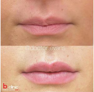 Dermal filler lip enhancement by Dr Mitch