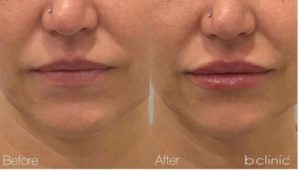 Dermal filler lip enhancement by Marian