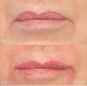 Dermal filler lip refresher and lip corner treatment by Dr Lee