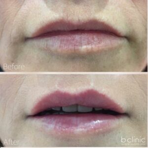 Dermal filler lip refresher treatment by Dr Frank