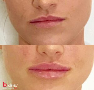 Dermal filler lips enhancement by Dr Lee