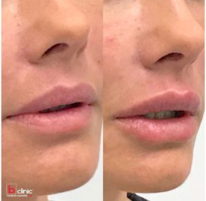 Dermal filler lip enhancement by Dr Lee