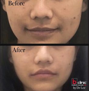 Dermal filler nasolabial folds treatment by Dr Lee