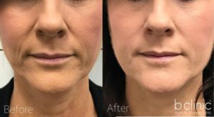 Dermal filler nasolabial folds treatment by Dr Lee