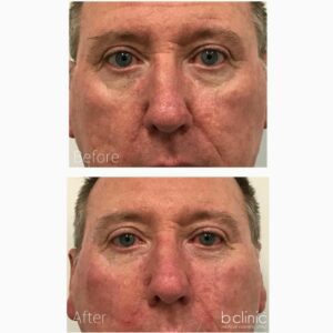 Dermal filler nasolabial folds treatment by Dr Luke