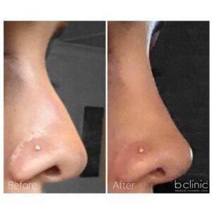 Dermal filler nose treatment by Dr Lee