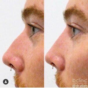 Dermal filler nose enhancement by Dr Elle