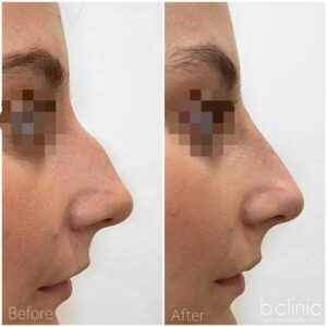 Dermal filler nose filler treatment by Dr Frank