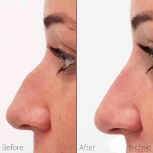 Dermal filler nose treatment by Dr Elle