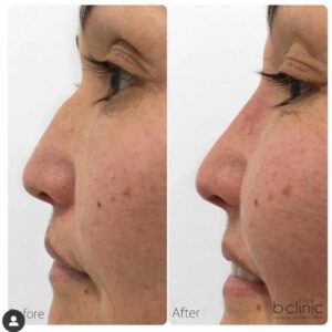 Dermal filler nose treatment by Dr Frank