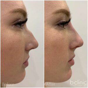 Dermal filler nose treatment by Dr Frank