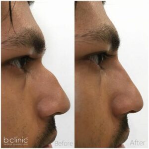 Dermal filler nose treatment by Dr Frank